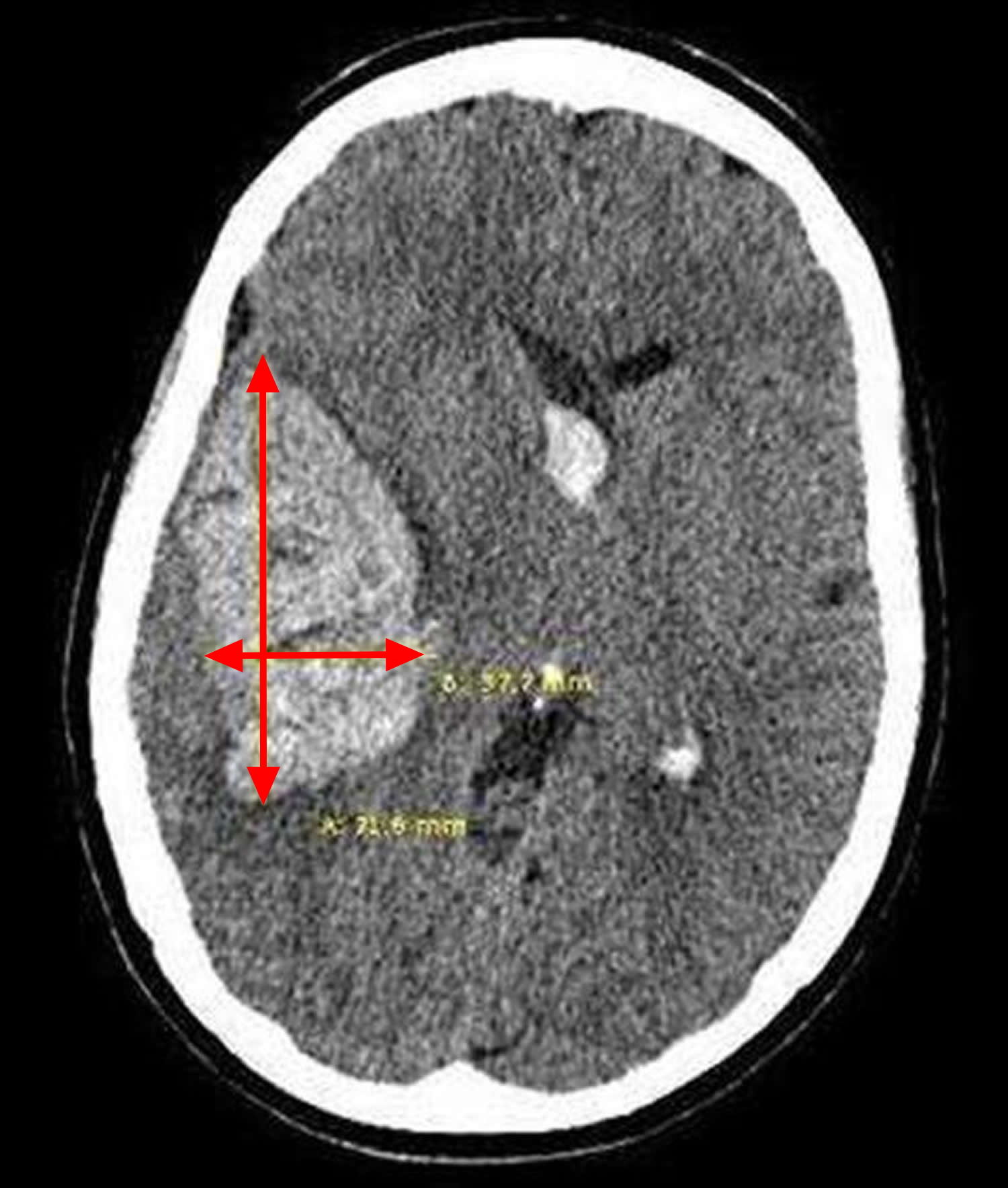 Intracranial Hematoma Rehab: Improve Brain Function